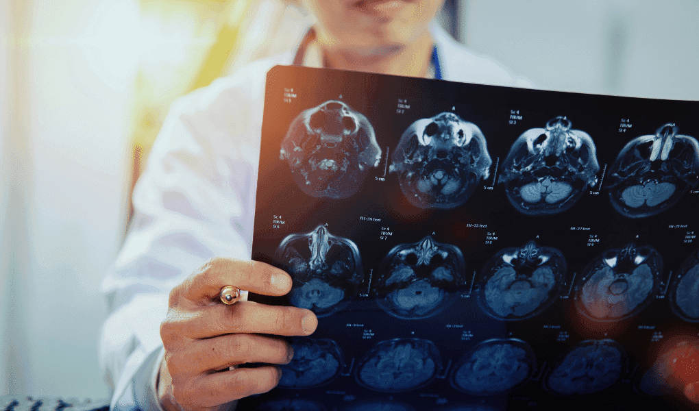 Traumatic Brain Injury Litigation: New Ways to Navigate TBI Cases Using Expert Witnesses