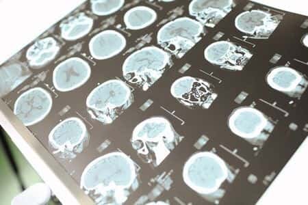 Patient’s Epilepsy Allegedly Due to Electroconvulsive Therapy