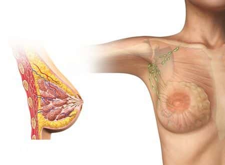 Failed Breast Augmentation Procedure Requires Numerous Corrective Surgeries