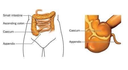 General Surgery Expert Witness Opines on Failure to Notice Acute Appendicitis